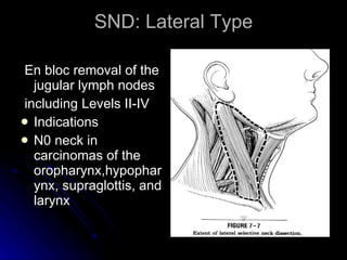 SND: Lateral Type <ul><li>En bloc removal of the jugular lymph nodes </li></ul><ul><li>including Levels II-IV </li></ul><u...