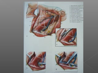 Neck Dissection Rcpa Neck dissections | PPT