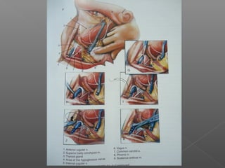 Neck Dissection Incision Apron Neck dissections | PPT