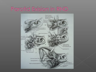 Neck Dissection Rcpa Neck dissections | PPT