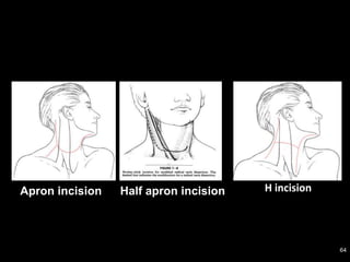 Neck Dissection Incision Apron Neck Dissections | PPTX
