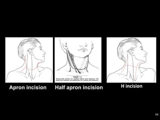 Apron incision Half apron incision
64
H incision
 