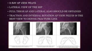 Traction Internal Rotation View Fracture Neck of Femur | PPTX