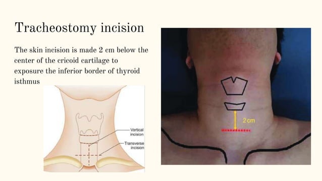Mid Neck Incision Neck incisions.pptx | Thyroid Disorders | Endocrine and Metabolic Diseases