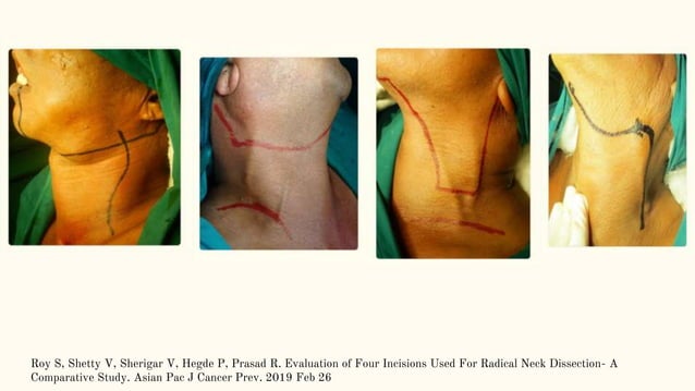 Commando Operatin Incision Neck incisions.pptx | Thyroid Disorders | Endocrine and Metabolic Diseases