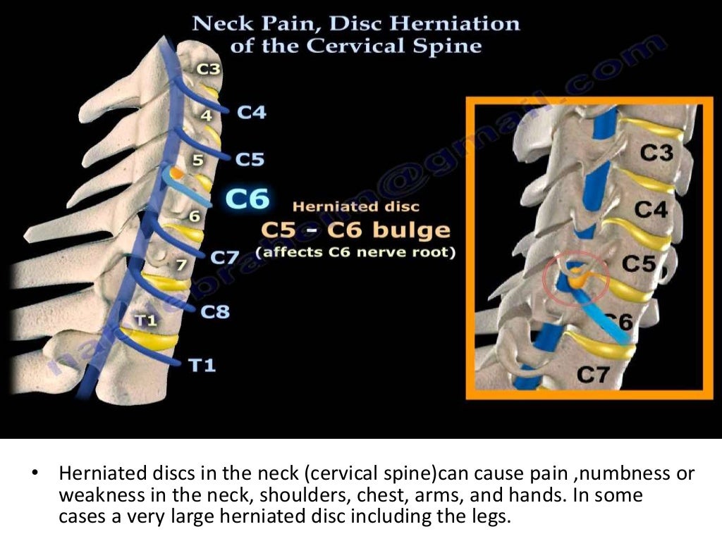 Neck Injuries in Sports