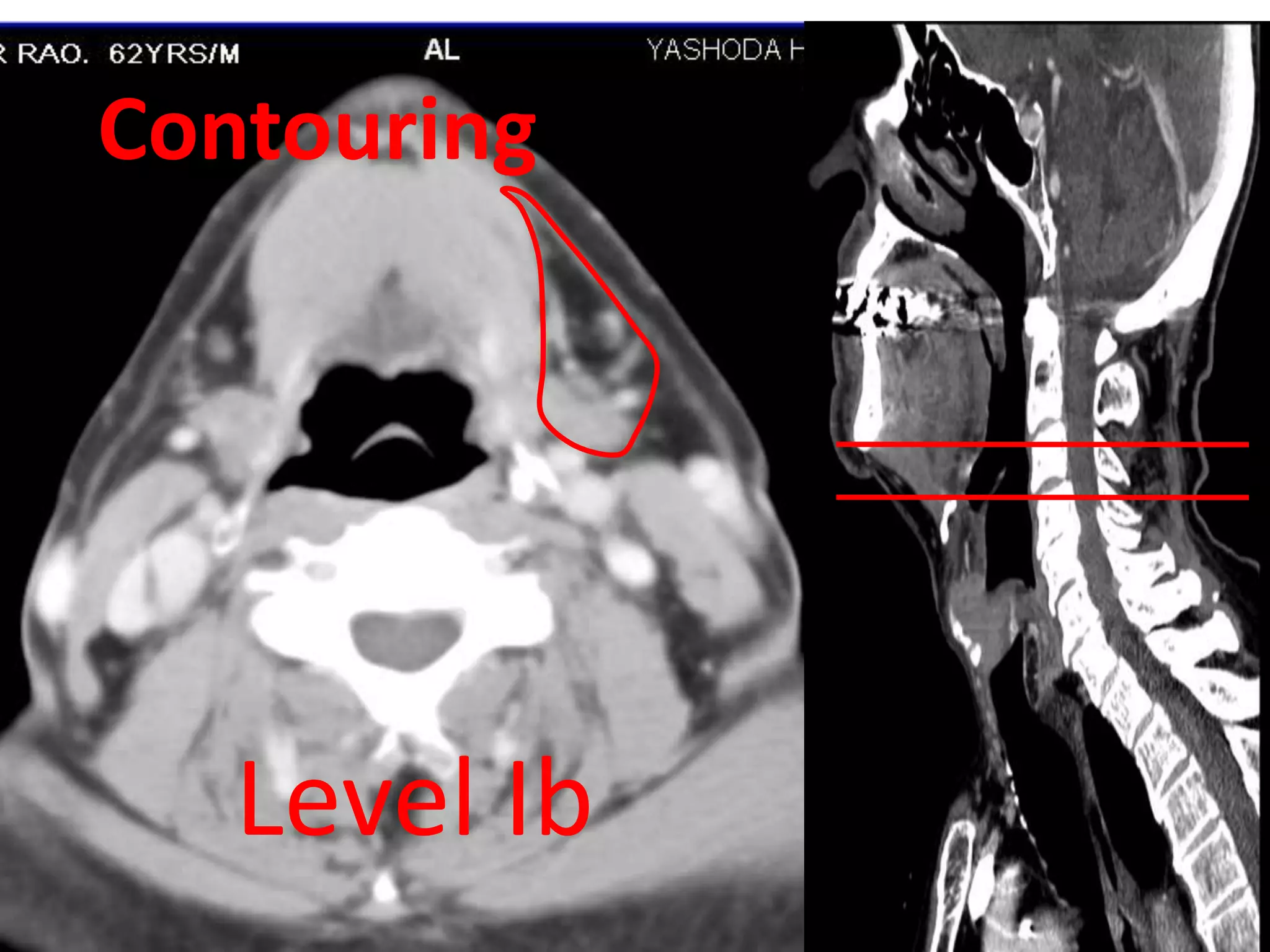 Neck node & Contouring Guidelines | PPTX