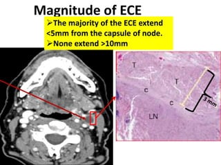 Margins of 1 cm from
the nodal GTV to the CTV
would be sufficient to
fully cover any subclinical
nodal extension for lymp...