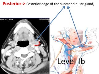 Posterior-> Posterior edge of the submandibular gland,
Level Ib
 