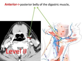 Anterior->posterior belly of the digastric muscle,
Level II
 