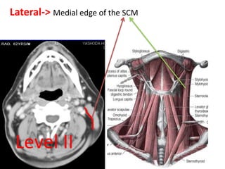 Lateral-> Medial edge of the SCM
Level II
 
