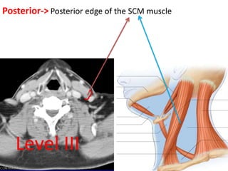 Posterior-> Posterior edge of the SCM muscle
Level III
 