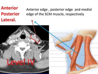 Anterior
Posterior
Lateral.
Level IV
Anterior edge , posterior edge and medial
edge of the SCM muscle, respectively
 