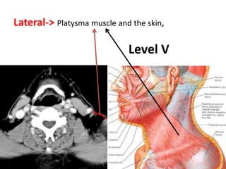 Lateral-> Platysma muscle and the skin,
Level V
 