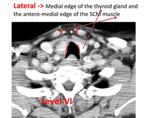 .
Lateral -> Medial edge of the thyroid gland and
the antero-medial edge of the SCM muscle
Level VI
 