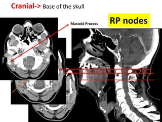 Cranial-> Base of the skull
Mastoid Process RP nodes
 