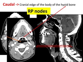 Caudal -> Cranial edge of the body of the hyoid bone
RP nodes
 