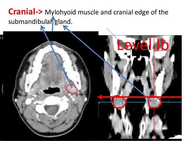Neck node & Contouring Guidelines
