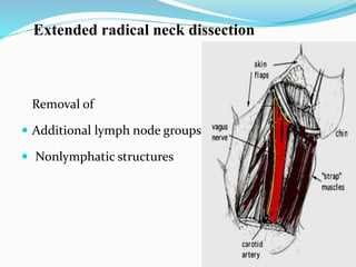 Removal of
 Additional lymph node groups
 Nonlymphatic structures
Extended radical neck dissection
 