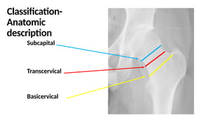 Comprehensive Management of Neck of Femur Fractures: Fixation Options ...