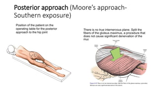 Moore Approach NECK OF FEMUR FRACTURE ORTHOPAEDICS.pptx