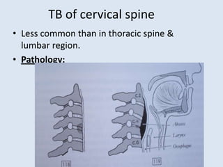 TB of cervical spine
• Less common than in thoracic spine &
lumbar region.
• Pathology:
 