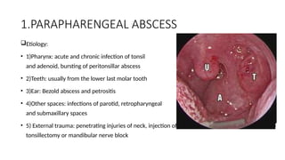 Abscess Block NECK SPACE INFECTIONS.pptx , neck spaces, neck abscess | PPTX