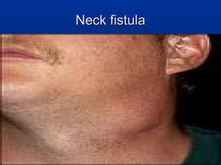 Neck fistula
 