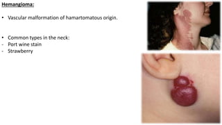 Hemangioma:
• Vascular malformation of hamartomatous origin.
• Common types in the neck:
- Port wine stain
- Strawberry
 
