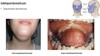 Sublingual dermoid cyst:
• Sequestration dermoid cyst
Infra myelohyoid dermoid Supra myelohyoid dermoid
 