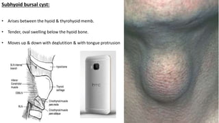 Subhyoid bursal cyst:
• Arises between the hyoid & thyrohyoid memb.
• Tender, oval swelling below the hyoid bone.
• Moves up & down with deglutition & with tongue protrusion
 