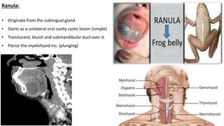 Ranula:
• Originate from the sublingual gland
• Starts as a unilateral oral cavity cystic lesion (simple)
• Translucent, bluish and submandibular duct over it.
• Pierce the myelohyoid ms. (plunging)
 