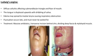 Ludwig’s angina:
• Diffuse cellulitis affecting submandibular triangle and floor of mouth.
• The tongue is displaced upwards with dribbling of saliva.
• Edema may spread to involve larynx causing respiratory obstruction.
• Fluctuation occurs late, and must never be waited for.
• Treatment: Massive antibiotics, transverse incision behind chin, dividing deep fascia & mylohyoid muscle.
 