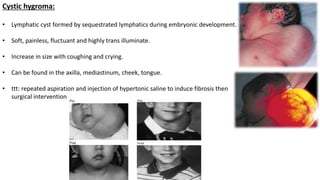 Cystic hygroma:
• Lymphatic cyst formed by sequestrated lymphatics during embryonic development.
• Soft, painless, fluctuant and highly trans illuminate.
• Increase in size with coughing and crying.
• Can be found in the axilla, mediastinum, cheek, tongue.
• ttt: repeated aspiration and injection of hypertonic saline to induce fibrosis then
surgical intervention
 