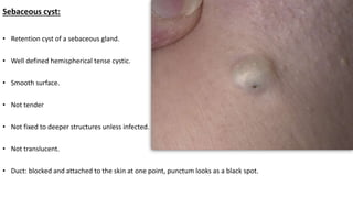 Sebaceous cyst:
• Retention cyst of a sebaceous gland.
• Well defined hemispherical tense cystic.
• Smooth surface.
• Not tender
• Not fixed to deeper structures unless infected.
• Not translucent.
• Duct: blocked and attached to the skin at one point, punctum looks as a black spot.
 