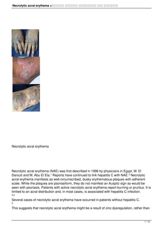 Necrolytic acral erythema =‫اﻠﺤﻤاﻤﻰ‬ ‫اﻠﻨﺨرﻴﺔ‬ ‫اﻠاﻨﺤﻠاﻠﻴﺔ‬ ‫ﻋﻠﻰ‬ ‫اﻠﻨﻬاﻴاﺖ‬
Necrolytic acral erythema
Necrolytic acral erythema (NAE) was first described in 1996 by physicians in Egypt, M. El
Darouti and M. Abu El Ela.1 Reports have continued to link hepatitis C with NAE.2 Necrolytic
acral erythema manifests as well-circumscribed, dusky erythematous plaques with adherent
scale. While the plaques are psoriasiform, they do not manifest an Auspitz sign as would be
seen with psoriasis. Patients with active necrolytic acral erythema report burning or pruritus. It is
limited to an acral distribution and, in most cases, is associated with hepatitis C infection.
3,4
Several cases of necrolytic acral erythema have occurred in patients without hepatitis C.
5
This suggests that necrolytic acral erythema might be a result of zinc dysregulation, rather than
1 / 13
 