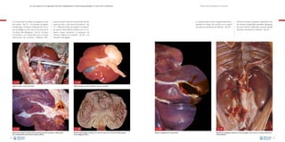 La necropsia en el ganado porcino, diagnóstico anatomopatológico y toma de muestras

Técnica de necropsia en el cerdo

tuando presión sobre la vesícula biliar (la bilis
tiene que fluir y salir hacia el duodeno) –Fig.
27–. Posteriormente se separan el estómago (que se abre desde el píloro por la curvatura mayor, valorando la presencia de
úlceras y edema en la pared) –Fig. 28– y el
duodeno, del hígado.

La vesícula biliar se abre longitudinalmente y
también se realiza una incisión en su pared
(se valora la presencia de edema) –Fig. 29–.

A continuación, se realiza una ligadura a nivel
del cardias –Fig. 25– y se extraen el hígado,
el estómago y duodeno (después de seccionar el esófago, la vena cava y la arteria aorta
a la altura del diafragma) –Fig. 26–. Se abre
el duodeno y se comprueba que no existe
obstrucción del conducto colédoco efec-

Fig. 25
Ligadura simple a la altura del cardias.

Fig. 27
Apertura del duodeno y presión sobre la vesícula biliar para comprobar la salida de bilis
por la desembocadura del conducto colédoco (flecha).
26

Antes de extraer el aparato urogenital se han
de extraer las glándulas adrenales (alargadas,
de color marrón y adheridas a la parte medial
del polo craneal de los riñones) –Fig. 30–.

Fig. 26
Hígado, estómago y parte del duodeno una vez ya extraídos.

Fig. 28
Apertura del estómago cortando por la curvatura mayor; en la zona central debe aparecer
la pars esofágica (círculo).

Fig. 29
Apertura longitudinal de la vesícula biliar.

Fig. 30
Situación de las glándulas adrenales, con forma alargada y color marrón, en el polo medial de los
riñones (flechas).
27

 