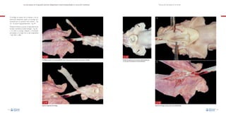 La necropsia en el ganado porcino, diagnóstico anatomopatológico y toma de muestras

Técnica de necropsia en el cerdo

El esófago se separa de la tráquea y de los
pulmones dejándolo sujeto a la laringe únicamente por su porción más craneal –Fig.
43–. Se abre longitudinalmente –Fig. 44–.

A

Posteriormente se ponen al descubierto las
tonsilas cortando el anillo faríngeo –Fig. 45–
y se abre la laringe, tráquea y bronquios
principales a lo largo de su eje longitudinal
–Figs. 46A y 46B–.

Fig. 43
El esófago se separa de la tráquea dejándolo sujeto únicamente por su posición más craneal a la laringe.

Fig. 44
Apertura longitudinal del esófago.
32

Fig. 45
Entrada de la glotis una vez cortado el anillo faríngeo que,
a la vez, pone al descubierto las tonsilas (flechas).

B

Fig. 46
Apertura de laringe y tráquea (A) y de los bronquios (B).
33

 