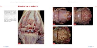 La necropsia en el ganado porcino, diagnóstico anatomopatológico y toma de muestras

Técnica de necropsia en el cerdo

Estudio de la cabeza
Es necesario separar la cabeza del cadáver
mediante una incisión ventral en la articulación atlantooccipital –Fig. 50–. Se aparta la
musculatura de los temporales y se procede
a la apertura de la caja craneana: se hace un
corte coronal sobre el techo del cráneo, a la
altura del ángulo lateral del ojo, y dos cortes
laterales por encima de los cóndilos del
occipital y dirigidos hacia los extremos del
corte coronal –Fig. 51–. Una vez realizados
estos cortes, ya se puede levantar la tapa del
cráneo –Fig. 52– y se separa la duramadre
(paquimeninge) –Fig. 53–.

Fig. 51
Líneas de corte en los huesos craneanos para la apertura de la cavidad craneal.

Fig. 50
Apertura de la articulación atlantooccipital con el objeto de separar la cabeza del cuerpo.
36

Fig. 52
Cortes marcados anteriormente ya realizados. Nótese la presencia de la duramadre cubriendo el
encéfalo.

Fig. 53
Misma foto anterior una vez se ha eliminado la duramadre.
37

 