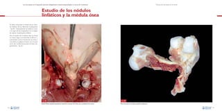La necropsia en el ganado porcino, diagnóstico anatomopatológico y toma de muestras

Técnica de necropsia en el cerdo

Estudio de los nódulos
linfáticos y la médula ósea
Se debe comprobar el estado de los nódulos linfáticos de las diferentes localizaciones
–Fig. 58–. Habitualmente se realiza un corte
a lo largo del eje longitudinal con el objeto
de valorar el parénquima linfático.
Para el estudio de la médula ósea se extrae
un hueso largo (normalmente el fémur) y
colocándolo contra el borde de una mesa o
una piedra, se golpea el hueso con el canto
romo del cuchillo, fracturando el hueso diagonalmente –Fig. 59–.

Fig. 58
Nódulos linfáticos inguinales superficiales. Es importante la valoración del tamaño, color y consistencia de los mismos.
40

Fig. 59
Fémur fracturado con el objeto de estudiar la médula ósea.
41

 