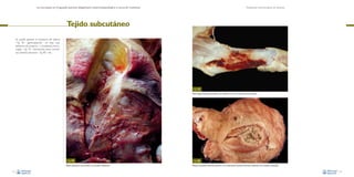La necropsia en el ganado porcino, diagnóstico anatomopatológico y toma de muestras

Evaluación macroscópica de vísceras

Tejido subcutáneo
Se puede apreciar la existencia de edema
–Fig. 78– (generalizando – en este caso
hablamos de anasarca – o localizado), hemorragias –Fig. 79–, hematomas, áreas necróticas, nódulos, abscesos –Fig. 80–, etc.

Fig. 79
Hemorragias subcutáneas asociadas a una infección por el virus de la peste porcina clásica.

Fig. 78
Edema subcutáneo muy marcado en un proceso septicémico.
52

Fig. 80
Absceso subcutáneo-muscular asociado a una contaminación bacteriana durante la aplicación de un producto inyectable.
53

 
