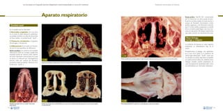 La necropsia en el ganado porcino, diagnóstico anatomopatológico y toma de muestras

Evaluación macroscópica de vísceras

Aparato respiratorio

Rinitis atrófica –Figs. 83 y 84–: caracterizada
por lo menos por un cierto grado de atrofia de los cornetes nasales. Se suele asociar a
toxinas de Bordetella bronchiseptica (rinitis
atrófica regresiva) o de Pasteurella multocida
tipo D (rinitis atrófica progresiva). La atrofia
de los cornetes puede llegar a ser muy marcada, con desviación del tabique nasal, hecho
que suele coincidir con desviación de la jeta.

Cavidad nasal
En la cavidad nasal se describen:
Anomalías congénitas. Son muy raras
en el cerdo. Se debe destacar la palatosquisis (paladar hendido, con falta de cierre entre
las fosas nasales y la cavidad bucal) –Fig. 81–.

•

Naso-faringe,
laringe y tráquea

•

Trastornos circulatorios. Congestión,
hemorragias y hematomas.

La incidencia de lesiones en estas regiones
anatómicas es relativamente baja en el
cerdo.

•

Inflamaciones. En el cerdo son frecuentes dos formas específicas de inflamación:
Rinitis exudativa con presencia de exudado
inflamatorio entre los cornetes nasales. Este
exudado puede ser catarral (rinitis catarral,
de hecho esta lesión macroscópica es la que
se asocia a la infección por citomegalovirus
porcino, rinitis por cuerpos de inclusión),
purulento (rinitis purulenta) o fibrinoso (rinitis fibrinosa –Fig. 82–).

Fig. 81
Hendidura del paladar duro en un lechón recién nacido
(palatosquisis).
54

Fig. 84
Fig. 82

Atrofia marcada de los cornetes nasales, con ligera desviación del tabique nasal hacia la derecha en un caso de rinitis atrófica.

Presencia de abundante exudado fibrinoso entre los cornetes nasales (rinitis fibrinosa).

Fig. 83
Atrofia muy marcada de los cornetes nasales de un caso de rinitis atrófica (izquierda) comparado con unos cornetes nasales
normales (derecha).

Probablemente el hallazgo más significativo
en la zona de la glotis, es la presencia de
hemorragias petequiales –Fig. 85–, dado que
se considera una lesión altamente compatible
con peste porcina clásica. No obstante, estos
hallazgos también podrían presentarse en
casos de septicemias bacterianas tales como
una salmonelosis por Salmonella choleraesuis.

Fig. 85
Hemorragias petequiales en la glotis de un cerdo afectado por peste porcina clásica.
55

 