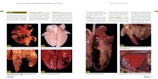 La necropsia en el ganado porcino, diagnóstico anatomopatológico y toma de muestras

Pulmón
La patología pulmonar es, juntamente con la
digestiva, causa de grandes pérdidas económicas en el sector porcino. Destacaremos
diferentes tipos de alteraciones patológicas:

• Anomalías congénitas. La más habitual

es la melanosis maculosa –Fig. 86–, consistente en la presencia de manchas negras en la
superficie pulmonar debidas a la migración
aberrante de melanocitos hacia el parénquima
pulmonar durante el período embrionario.

Fig. 86
Manchas negras de diámetro variable en la superficie pulmonar (melanosis congénita).

Fig. 88
Áreas multifocales de colapso pulmonar (atelectasia adquirida); esta lesión tiene un aspecto
macroscópico similar al de la neumonía enzoótica.
56

• Atelectasia. Colapso del pulmón por falta

de aire en el interior del parénquima pulmonar.
Puede afectar difusamente a todo el pulmón
(suele ser atelectasia fetal –Fig. 87–, es decir,
cerdos nacidos muertos que no han respirado) o focalmente (habitual en animales muy
jóvenes en los cuales todavía no se ha dado la

Evaluación macroscópica de vísceras

total expansión del pulmón (atelectasia fetal), o
en animales de cualquier edad por causas
diversas (atelectasia adquirida) –Fig. 88–.

alveolar). En algunos casos también se observa la presencia de aire a nivel subpleural formando bullas (enfisema bulloso –Fig. 89–).

• Enfisema. Cúmulo de aire en los tabi-

Trastornos circulatorios. Hemorragias
–Fig. 90–, trombosis, infartos y edema. El
edema puede ser intersticial –Fig. 91– cuando
afecta a los tabiques interlobulares e interlobe-

ques interlobulillares (enfisema intersticial) o
en el parénquima pulmonar debido a la ruptura de los tabiques interalveolares (enfisema

Fig. 91

Fig. 87

Tabiques interlobulillares muy evidentes debido a la acumulación de líquido en el espacio
intersticial (edema intersticial).

Aspecto del pulmón de un lechón nacido muerto (atelectasia fetal).

Fig. 89
Formación de bullas de aire subpleurales (enfisema bulloso).

•

lares (distensión de los tabiques interlobulillares
por líquido),y alveolar cuando afecta a los alvéolos, observable como un aumento generalizado del volumen del pulmón (pulmón “acampanado”) con una pleura brillante, y con presencia de líquido espumoso en la tráquea y los
bronquios. El edema alveolar suele acompañarse de congestión pulmonar –Fig. 92–.

Fig. 90
Hemorragias marcadas en la región dorsal del pulmón.

Fig. 92
Edema y congestión pulmonares; nótese el enrojecimiento del pulmón y la ausencia de colapso.
57

 