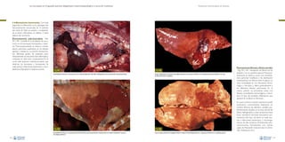 La necropsia en el ganado porcino, diagnóstico anatomopatológico y toma de muestras

Evaluación macroscópica de vísceras

•

Inflamaciones (neumonía). Con toda
seguridad, la inflamación es la patología más
frecuentemente encontrada en el pulmón
del cerdo. En base al carácter y localización
de la lesión inflamatoria se definen 5 tipos
básicos de neumonía:
Bronconeumonía catarral-purulenta –Figs.
93 y 94–: consiste en la exudación de pus y
moco en los bronquios, bronquiolos y alvéolos. Macroscópicamente se observa consolidación pulmonar, usualmente en los lóbulos
apicales y medios en su porción ventral. Existen diferentes grados de extensión, pero
habitualmente se encuentra bien delimitada y
confinada en esta zona craneoventral. En el
corte suele aparecer material purulento que
obstruye los bronquios y bronquiolos. Se
suele asociar a infecciones bacterianas y micoplásmicas (Mycoplasma hyopneumoniae).

❋

Fig. 93
Consolidación pulmonar craneoventral con moderada afectación del lóbulo diafragmático (bronconeumonía catarral-purulenta).

Fig. 94
Consolidación pulmonar craneoventral (bronconeumonía catarral-purulenta) conjuntamente con edema intersticial y ausencia
de colapso pulmonar.
58

Fig. 95
Áreas multifocales de necrosis hemorrágica (asterisco) y presencia de fibrina en la superficie pulmonar (flecha) en un caso
de pleuroneumonía contagiosa.

Fig. 96

Pleuroneumonía fibrinosa o fibrino-necrótica
–Figs. 95 y 96–: exudación de fibrina en los
alvéolos y en la superficie pleural. Macroscópicamente se observa como una consolidación pulmonar multifocal o de distribución
craneoventral, con fibrina sobre la pleura. La
zona consolidada es con frecuencia hemorrágica y necrótica, y afecta gradualmente a
los diferentes lóbulos pulmonares. En el
mismo pulmón se encuentran áreas con
lóbulos consolidados, hemorrágicos y necróticos. El tipo de exudado inflamatorio que
aparece en la pleura es fibrinoso.
En casos crónicos, la lesión pulmonar puede
evolucionar convirtiéndose finalmente en
nódulos fibrosos de diámetro variable, preferentemente situados en la zona dorsal del
lóbulo diafragmático, o bien evoluciona hacia
focos necróticos cerrados (secuestros pulmonares). Este tipo de lesión se suele asociar a infecciones bacterianas y microorganismos de alta virulencia (Actinobacillus pleuropneumoniae, Actinobacillus suis, ciertas
cepas de Pasteurella multocida tipo A, Salmonella choleraesuis, etc.).

Caso de pleuroneumonía contagiosa donde se observa hemorragia pulmonar y presencia de fibrina en la superficie pleural.
59

 