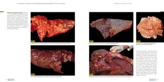 La necropsia en el ganado porcino, diagnóstico anatomopatológico y toma de muestras

Evaluación macroscópica de vísceras

Neumonía bronquiolo-intersticial –Figs. 100
y 101–:es equivalente a la anterior,pero suele
encontrarse más circunscrita a los lóbulos
pulmonares apical y medio, además de presentar necrosis bronquiolar. La imagen
macroscópica es prácticamente idéntica a la
descrita en la neumonía intersticial, aunque
las lesiones están distribuidas básicamente en
los lóbulos mencionados.Algunos virus (virus
de la influenza porcina) y micoplasmas
(Mycoplasma hyopneumoniae) se suelen asociar a este tipo de lesión.

Fig. 100
Consolidación pulmonar craneoventral multifocal en un caso de neumonía enzoótica (neumonía bronquiolo-intersticial).

Fig. 101
Neumonía bronquiolo-intersticial en un caso de infección por el virus de la influenza porcina.
62

Fig. 102
Pleuritis fibrinosa difusa muy intensa en un caso de infección por Haemophilus parasuis.

Fig. 104

Fig. 103
Pleuritis fibrinosa sin reacción inflamatoria del parénquima
pulmonar en un caso de enfermedad de Glässer.

En el pulmón también se describen inflamaciones de la pleura (pleuritis). La forma más
habitual de inflamación de la pleura es el
depósito de exudado inflamatorio fibrinoso
en su superficie, sea de forma focal o difusa
(pleuritis fibrinosa –Figs. 102 y 103–). Este
tipo de lesión se suele asociar a bacterias
que producen cuadros de poliserositis, tales
como Haemophilus parasuis, Streptococcus
suis, Escherichia coli y Mycoplasma hyorhinis,
así como a todas aquéllas capaces de producir una neumonía fibrinosa o fibrinonecrotizante. La reorganización de esta fibrina supone la aparición de tejido conjuntivo
fibroso, que da lugar a su vez, a adherencias
entre las pleuras (pleuritis fibrosa o fibroadhesiva –Fig. 104–).

Adherencias fibrosas (flecha) entre pleura parietal y visceral (pleuritis fibrosa) como secuela de una antigua infección bacteriana sistémica.
63

 