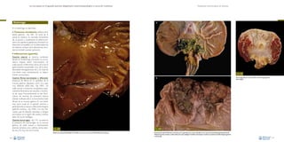 La necropsia en el ganado porcino, diagnóstico anatomopatológico y toma de muestras

Estómago

Evaluación macroscópica de vísceras

A

En el estómago se describen:

•

Trastornos circulatorios (edema de la
pared gástrica) –Fig. 108–. Al corte de la
pared se observa un marcado incremento
de su grosor, y visualmente el edema presenta una apariencia gelatinosa. Esta lesión es
altamente compatible con la enfermedad de
los edemas, aunque otras alteraciones circulatorias también pueden generarla.

• Inflamaciones (gastritis).
Gastritis catarral: se observa contenido
líquido en el estómago. De hecho no se evidencia ninguna lesión macroscópica. Se
suele asociar a infecciones víricas (virus de la
gastroenteritis transmisible, virus de la encefalomielitis hemaglutinante, etc.). Se trata de
una lesión cuya caracterización es básicamente microscópica.
Gastritis fibrino-necrotizante o difteroide:
presencia de fibrina en la superficie de la
mucosa gástrica, dispuesta como una capa
muy adherida sobre ésta –Fig. 109A–. Se
suele asociar a trastornos circulatorios, especialmente fenómenos de vasculitis y trombosis de vasos. Frecuentemente se dan fenómenos de necrosis de extensión diversa
(desde confinada sólo a la zona fúndica hasta
difusa) en la mucosa gástrica. Es una lesión
muy poco usual en el ganado porcino, y
generalmente se asocia a infecciones fúngicas
(gastritis micótica, –Fig. 109B–). Es muy frecuente que las lesiones asociadas a hongos
se localicen en la región del cardias, a ambos
lados de la pars esofágica.
Gastritis hemorrágica –Fig. 110–: se observa
la presencia de hemorragias en la mucosa
gástrica. Se suele asociar a intoxicaciones
diversas (arsénico, zinc, cadmio, ciertas plantas, etc.). Es muy rara en el cerdo.

Fig. 110
B

Fig. 108
Edema de la pared del estómago tras realizar un corte en un caso de enfermedad de los edemas.

66

Hemorragia difusa en la pars fúndica del estómago (gastritis
hemorrágica).

Fig. 109
Presencia de material fibrinoso y necrótico en la superficie de la mucosa del píloro en un caso de salmonelosis gastrointestinal (A).
Material necrótico situado a ambos lados de la pars esofágica. El análisis microscópico confirma la presencia de hifas fúngicas (gastritis
micótica) (B).
67

 