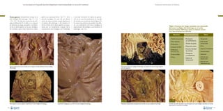 La necropsia en el ganado porcino, diagnóstico anatomopatológico y toma de muestras

Úlcera gástrica: habitualmente situada en la
pars esofágica del estómago –Figs. 111, 112,
113 y 114–. Se trata de un proceso de etiología multifactorial. En la tabla 2 se resumen
los factores de riesgo asociados a la presencia de la úlcera gástrica en la pars esofágica.
Se considera que la fase inicial de la úlcera

gástrica es la paraqueratosis –Fig. 115– de la
porción esofágica. En caso de una úlcera
activa se suele encontrar sangre digerida en
el interior del estómago o del intestino. La
forma crónica de la úlcera gástrica se caracteriza por un hundimiento irregular de la
mucosa de la pars esofágica, con moderada

Evaluación macroscópica de vísceras

a marcada formación de tejido de granulación en la cual, frecuentemente, los bordes
de la lesión se encuentran hemorrágicos. En
los casos más extremos se pueden dar, debido a la cicatrización de la pars esofágica, la
total oclusión del esófago a su entrada en el
estómago –Fig. 116–.

Tabla 2. Factores de riesgo asociados con ulceración
de la pars esofágica del estómago en el cerdo.
(Fuente: Friendship, 1999; Gastric Ulcers, En: Diseases of Swine,
Iowa State University Press, 685-594).
Nutrición

• Tamaño de partícula
• Tipo de grano
• Molturación
• Ausencia de fibra
• Deficiencia
de vit. E y Se

• Grasa oxidada
• Ayuno

Manejo/Instalaciones

• Producción
en confinamiento

• Tamaño de granja
• Mezcla de cerdos
• Excesiva densidad
de animales

• Transporte
y manipulación

• Sistema de
alimentación

Otros

• Temporada
• Enfermedad
concurrente

• Parto
• Aspectos hereditarios
• Somatotropina
• Histamina
• Infección por
Ascaris suum

• Infección por
Fig. 111
Ligeras erosiones de la mucosa situadas en los márgenes verticales (flechas) de la pars esofágica
del estómago.

Fig. 112
Úlcera gástrica crónica de aspecto crateriforme en la pars esofágica del estómago.
68

Helicobacter spp

Fig. 114
Úlcera gástrica de la pars esofágica del estómago con presencia de restos de sangre digerida
(de color negruzco).

Fig. 113
Cicatrización subsiguiente a una úlcera en la pars esofágica del estómago.

Fig. 115
Hiperplasia paraqueratótica (paraqueratosis) marcada de la pars esofágica del estómago.

Fig. 116
Oclusión del cardias, secundaria a una úlcera gástrica en la pars esofágica cicatrizada, con marcada
hipertrofia de la musculatura del esófago.
69

 