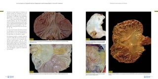 La necropsia en el ganado porcino, diagnóstico anatomopatológico y toma de muestras

Evaluación macroscópica de vísceras

También se puede observar la existencia de
lesiones erosivas y/o ulcerativas en la pars
fúndica del estómago. Se trata de alteraciones focales o multifocales que profundizan
ligeramente en la mucosa (erosiones, –Fig.
117–) o bien hasta la submucosa o la túnica
muscular (úlceras, –Fig. 118–). En este último
caso, si el estímulo que provoca la úlcera gástrica es suficientemente persistente, se puede
llegar a perforar la pared gástrica –Fig. 119–,
generando consecuentemente una peritonitis –Fig. 120–.
La causa más frecuente de lesiones erosivas
y/o ulcerativas en la pars fúndica del estómago del cerdo es el uso de antiinflamatorios
no esteroideos vía oral (pienso o agua).
No obstante, también se pueden observar
erosiones multifocales en la pars fúndica asociadas a un trastorno de la circulación: infartos de la mucosa gástrica –Fig. 121–. Estos
infartos suelen asociarse a infecciones bacterianas entéricas (tales como salmonelosis) o
infecciones bacterianas entéricas que producen toxemia (tales como Escherichia coli en
casos sobreagudos y agudos de colibacilosis
post-destete).

Fig. 117
Pequeñas erosiones de la mucosa gástrica de la pars fúndica asociadas al uso de antiinflamatorios no esteroideos (AINES)
administrados vía oral.

Fig. 118
Úlcera de la mucosa de la pars fúndica del estómago (flecha) asociada a una sobredosis de AINES administrados vía oral.
70

Fig. 119
Perforación de la pared gástrica a la altura de la pars fúndica
del estómago, también asociada a una sobredosis de AINES
administrados vía oral.

Fig. 120
Peritonitis fibrinosa secundaria a la perforación de la pared
gástrica mostrada en la figura anterior.

Fig. 121
Pequeñas erosiones multifocales en la mucosa gástrica de la pars fúndica asociadas a infartos causados por infecciones bacterianas
entéricas.
71

 