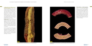 La necropsia en el ganado porcino, diagnóstico anatomopatológico y toma de muestras

Evaluación macroscópica de vísceras

Enteritis fibrinosa o fibrino-necrotizante
–Figs. 126 y 127–: consiste en el depósito de
fibrina en la pared del intestino delgado,
especialmente yeyuno e íleon. Habitualmente se encuentra el exudado inflamatorio tapizando la mucosa, pero en algunos casos la
fibrina se encuentra en el interior de la luz
intestinal, organizada en forma de cilindros
que ocupan toda la luz entérica. Microscópicamente, con frecuencia, se observa necrosis
de la mucosa intestinal. Se suele asociar a
algunas infecciones bacterianas (caso de salmonelosis) y algunas infestaciones protozoarias (caso de coccidiosis).

• Inflamación (de las diferentes por-

ciones del intestino). Se utiliza la terminología de enteritis para denominar a las inflamaciones del intestino delgado, especialmente del yeyuno; ileitis, para la inflamación específica del íleon; tiflitis, para la inflamación del
ciego; colitis, para la inflamación del colon; y
proctitis, para la inflamación del recto).
Dependiendo del número de segmentos
afectados se pueden combinar las mencionadas terminologías (tiflo-colitis, entero-colitis,
etc.). En base al carácter y a la localización del
exudado/infiltrado inflamatorio se definen
8 patrones de inflamación intestinal:
Enteritis catarral: es el diagnóstico anatomopatológico habitualmente utilizado para
designar alteraciones digestivas del intestino
delgado que cursan con un contenido totalmente líquido, de color variable. En algunos
casos, no existe ninguna lesión microscópica
en la mucosa intestinal, y la diarrea suele estar
mediada por toxinas de bacterias (caso de
Escherichia coli, por ejemplo): diarrea osmótica o secretora.
En otros casos la lesión microscópica asociada es la de atrofia y fusión de vellosidades
intestinales, provocando un efecto limpio de
malabsorción y mala digestión debido a la
alteración de la mucosa (caso de infecciones
víricas por coronavirus y rotavirus, aunque
también se observa en casos de colibacilosis
post-destete y coccidiosis).

Fig. 126
Marcada presencia de fibrina en la luz intestinal (enteritis fibrinosa) en un caso de salmonelosis entérica.
74

Fig. 127
Presencia de material fibrinoso y necrótico adherido a la mucosa del intestino delgado (enteritis fibrino-necrotizante) en un caso de
coccidiosis porcina.
75

 