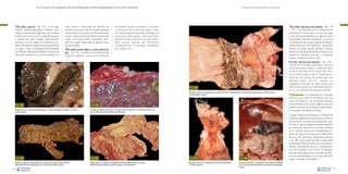 La necropsia en el ganado porcino, diagnóstico anatomopatológico y toma de muestras

Tiflo-colitis catarral –Fig. 132–: es el diagnóstico anatomopatológico utilizado para
designar alteraciones digestivas del intestino
grueso que cursan con un contenido pastoso
o líquido, de color variable, habitualmente
verdoso, y en los cuales no se observa exudado inflamatorio visible macroscópicamente
en ciego y colon. Histológicamente presenta
un infiltrado inflamatorio linfoplasmocitario de
intensidad variable en la mucosa intestinal. Se

suele asociar a infecciones de bacterias de
mediana virulencia (caso de la espiroquetosis
intestinal porcina causada por Brachyspira pilosicoli) y a alteraciones del intestino grueso de
origen nutricional (colitis inespecífica). También es la lesión observada en algunos casos
de salmonelosis.
Tiflo-colitis hemorrágica o muco-hemorrágica –Fig. 133–: consiste en la presencia de
sangre no digerida y moco en el contenido

Evaluación macroscópica de vísceras

Tiflo-colitis ulcerativa-necrotizante –Figs. 134
y 135–: caracterizada por la presencia de
erosiones y/o úlceras de la mucosa del ciego
y del colon acompañadas, en algunos casos,
de exudado inflamatorio fibrinoso y necrosis.
La distribución de la lesión puede ser difusa o
multifocal en forma de “botones” o pequeños
nódulos. Se suele asociar también a ciertas
infecciones de bacterias de alta virulencia (salmonelosis, disentería porcina) y, ocasionalmente, a parásitos (Trichuris suis).
Proctitis fibrino-necrotizante –Fig. 136–:
consiste en la erosión, ulceración y necrosis
de las porciones media y caudal del recto,
en forma de anillo. En los casos más crónicos, la lesión puede implicar cicatrización y
retracción de la zona, de manera que esta
estenosis rectal –Fig. 137– provoca un
megacolon marcado. Se suele asociar con
infecciones crónicas por Salmonella typhimurium y con secuelas de prolapsos rectales.

del intestino grueso. Se observa un aumento del grosor de la pared del ciego y colon,
con hemorragias de extensión variable en la
mucosa. Se suele asociar a infecciones bacterianas de alta virulencia (caso de la disentería porcina causada por Brachyspira
hyodysenteriae) y a parasitosis intestinales
por Trichuris suis.

Fig. 136
Necrosis y fibrina en la superficie de la mucosa del recto (proctitis fibrino-necrotizante). Lesión asociada a formas crónicas
de salmonelosis entérica.

B
Fig. 132
Presencia de un contenido intestinal pastoso con restos de pienso sin digerir en el colon
(colitis catarral).

Fig. 134
Presencia marcada de fibrina adherida a la mucosa del ciego y colon proximal
(tiflo-colitis fibrino-necrotizante) en un caso de salmonelosis entérica.
78

Fig. 133
Presencia de material mucinoso y de restos de fibrina adheridos a la mucosa del colon en un
caso de disentería porcina (colitis muco-fibrinosa).

Fig. 135
Imagen similar a la anterior, con presencia de fibrina especialmente en el ciego
(tiflitis fibrino-necrotizante), también asociada a una salmonelosis.

Fig. 137
Estenosis rectal como consecuencia de la lesión presentada
en la figura anterior.

Fig. 138

• Neoplasias. Las neoplasias en el ganado

porcino, y por ende las intestinales, son muy
raras. De entre las más frecuentes destacamos el linfosarcoma, que en algunos casos se
puede encontrar en el intestino, habitualmente asociado a las placas de Peyer.
A pesar de que el peritoneo no corresponde
al aparato digestivo, la mayor parte de éste se
encuentra en la cavidad peritoneal. Ello supone que el aparato digestivo puede afectarse
por extensión directa de una lesión presente
en la cavidad abdominal. Probablemente la
lesión de mayor importancia es la inflamación
fibrinosa del peritoneo (peritonitis fibrinosa
–Fig. 138–), que suele asociarse a infecciones
bacterianas sistémicas tales como las producidas por Haemophilus parasuis o Streptococcus
suis. No obstante, como ya se ha señalado,
también puede generarse una peritonitis fibrinosa secundariamente a una rotura del estómago o también del intestino.

Depósito de fibrina en la superficie de los órganos intestinales
en un caso de poliserositis fibrinosa causado por Haemophilus
parasuis.
79

 